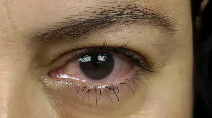Red Crying Eye Picture