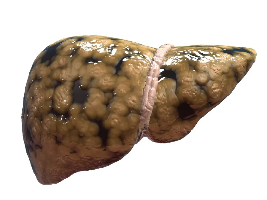 High quality photo of human fatty liver