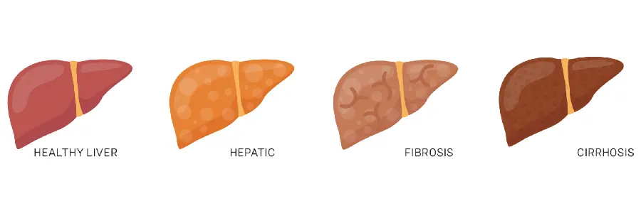 Photo of human fatty liver and healthy human liver