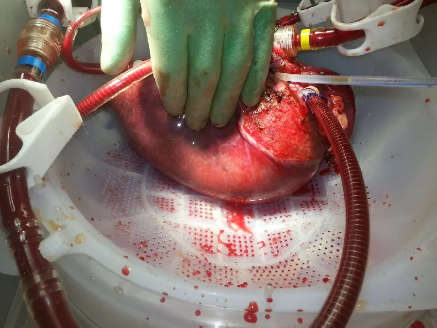 Photo of human liver surgery by surgeon