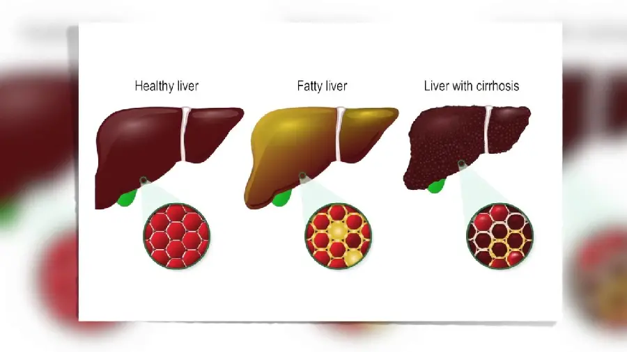 Photo comparing healthy liver with fatty liver