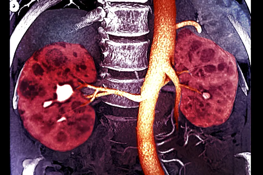 Photo of kidney in real human body