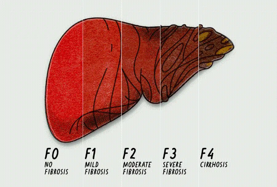 Photo of human fatty liver grading