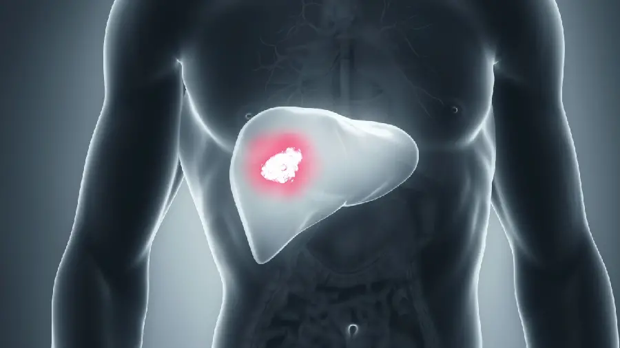 Photo of a cancerous tumor in the human liver