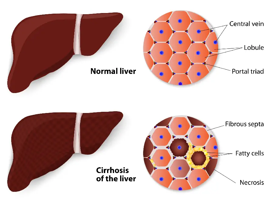 Photo of a fatty liver next to a healthy liver with details
