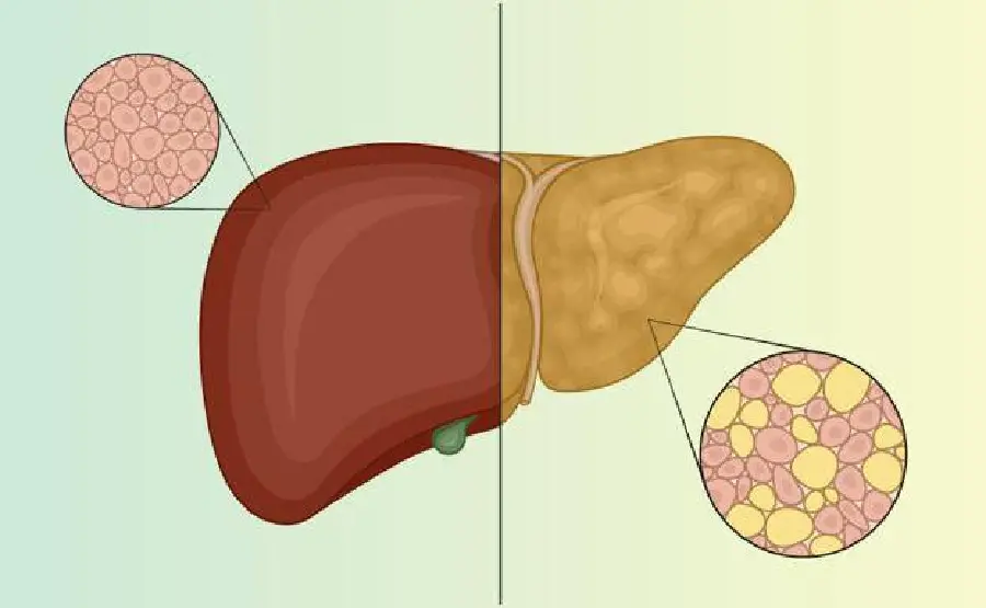 Photo of Healthy Liver and Fatty Liver