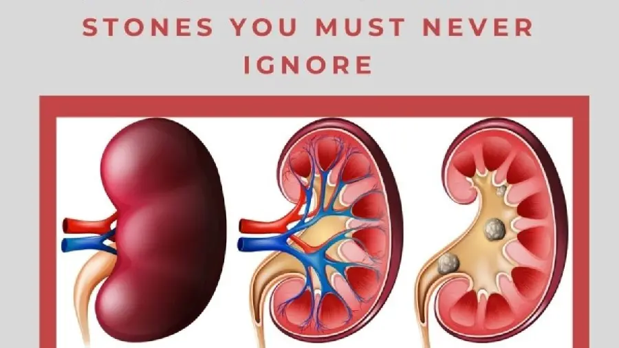 Photo of human kidney stones in color