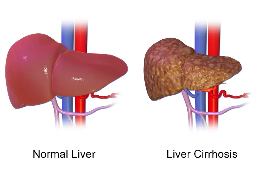 Photo of a fatty liver grade 2 and a healthy human liver