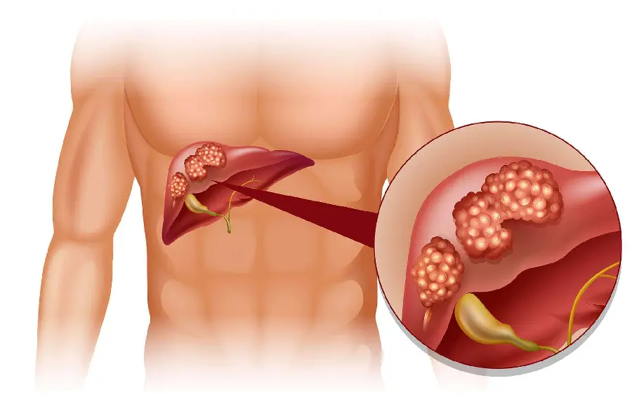 Very high quality photo of cancerous liver