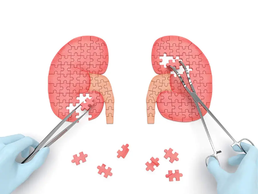 Photo of kidney stones in puzzle form with surgical scissors