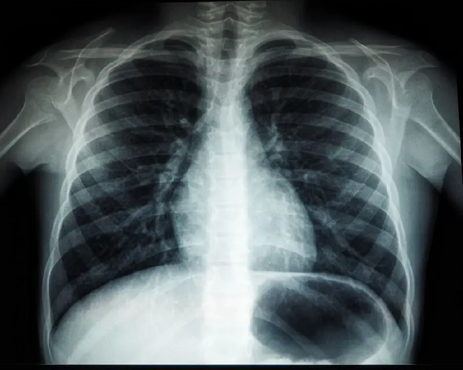Detailed Chest Radiology Image for Medical Enthusiasts