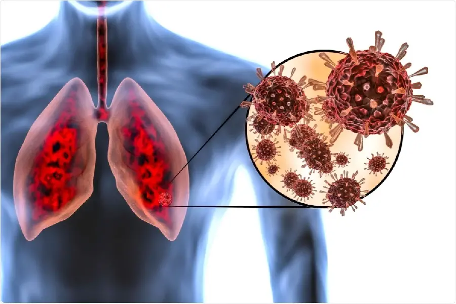 Photo of a corona-infected lung in high quality