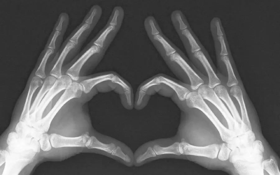 Radiology photo of hand showing heart for profile
