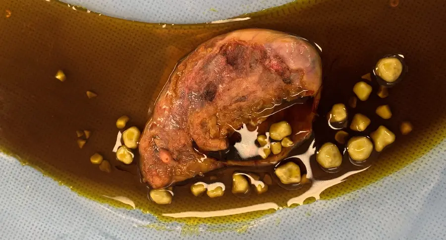 Gallbladder