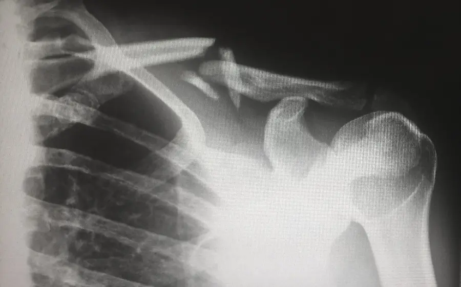 Painful scapular fracture radiology in excellent quality 8K