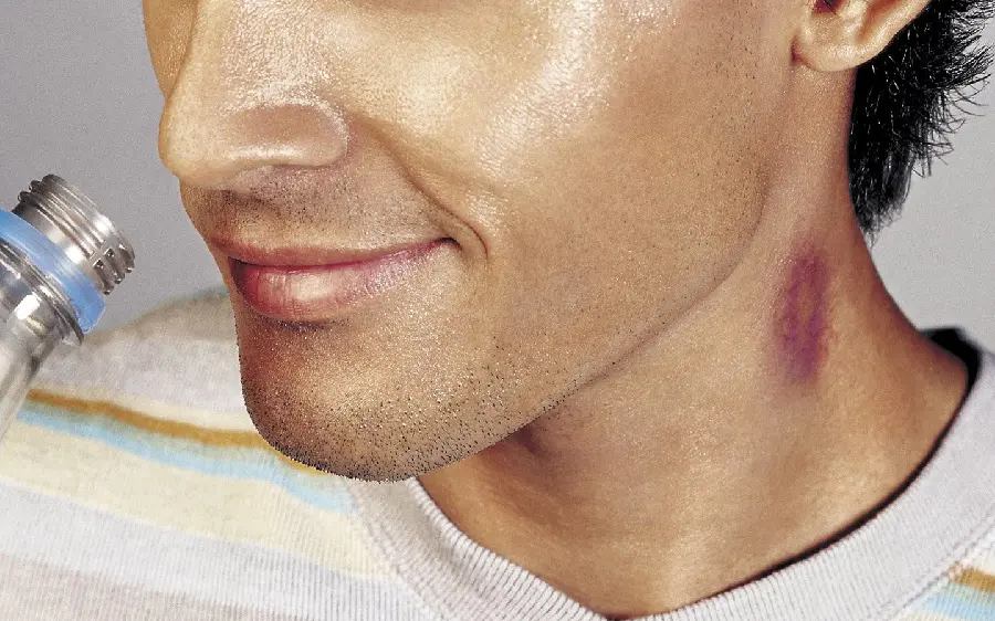 Interesting photo of removing bruises on the neck by drinking water