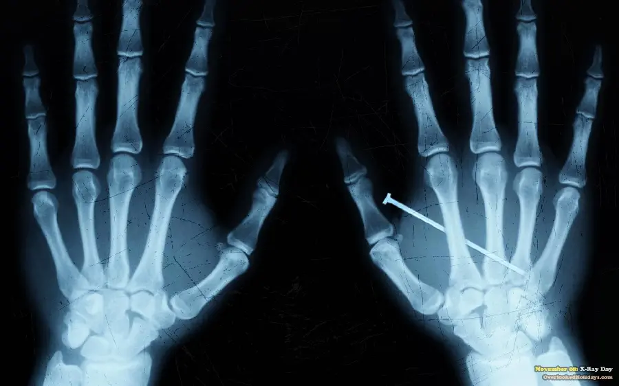 Download strange radiology image of a nail stuck in the hand 2023