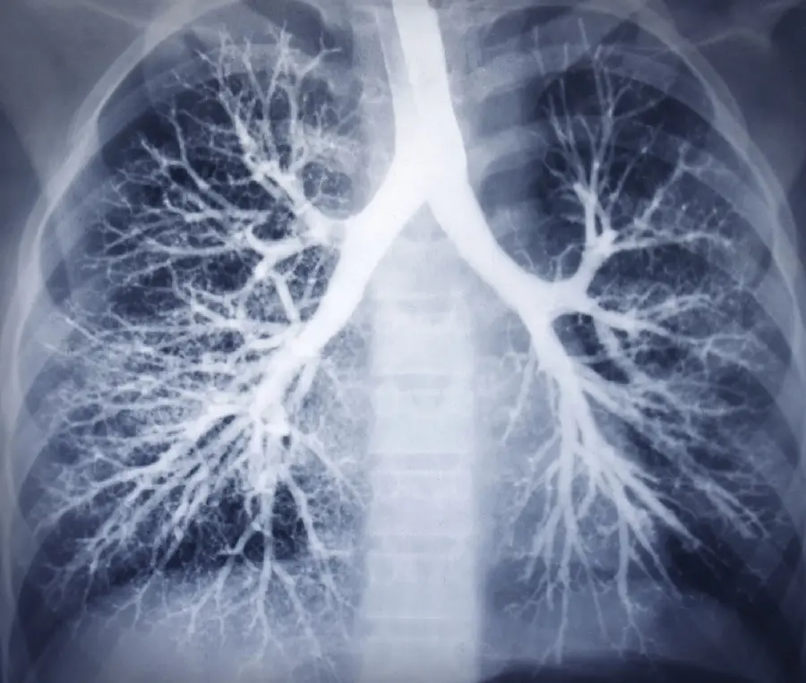Radiology photo of the human lung and respiratory system