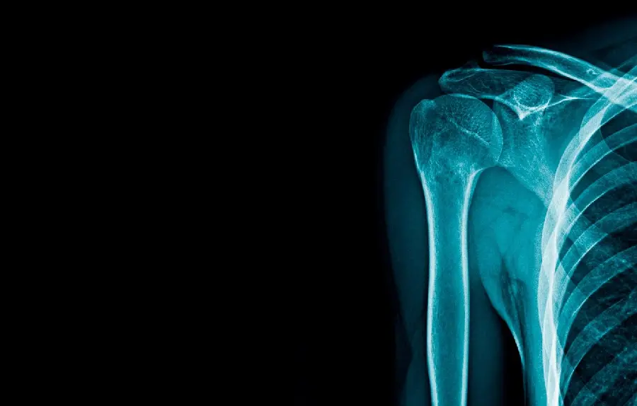 Download Full HD radiology image of the shoulder-arm joint