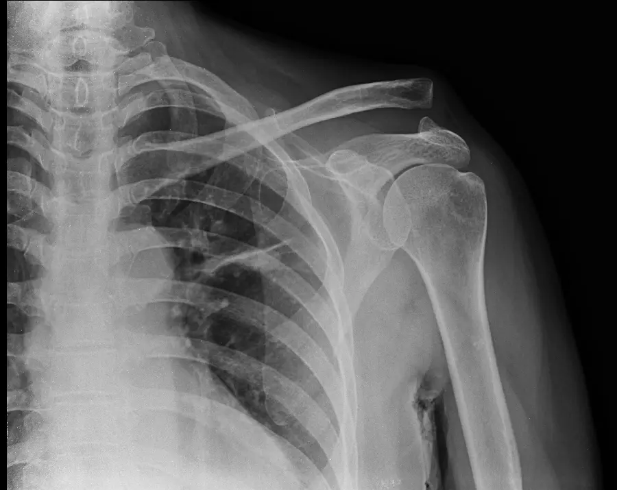 Dislocation of the dorsal scapula in radiology photo 1401