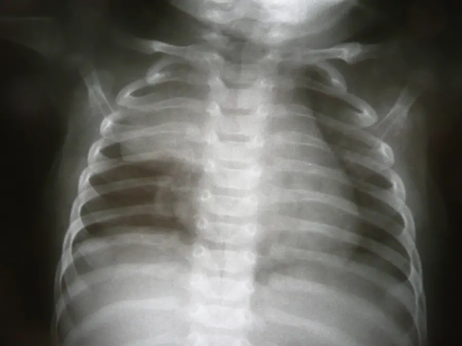 Lung and Chest Radiology in JPG Format Completely Free