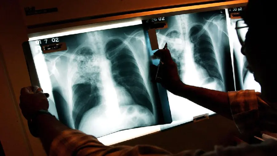 Photo of a human lung in radiology