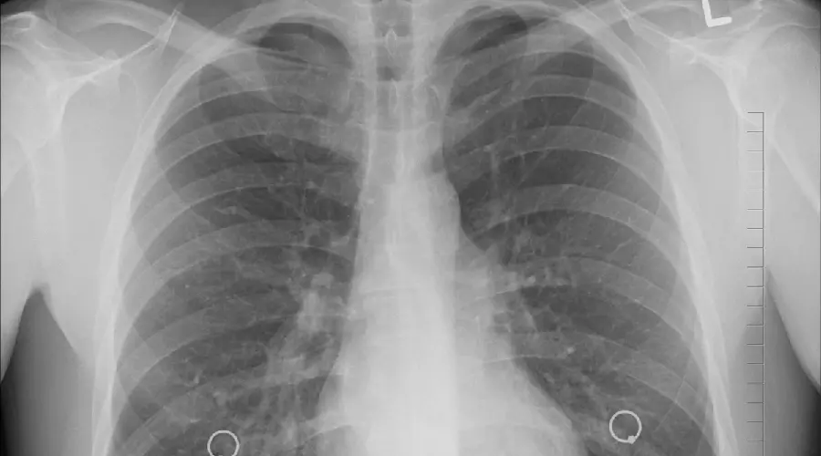Download radiology image of human lung and respiratory system
