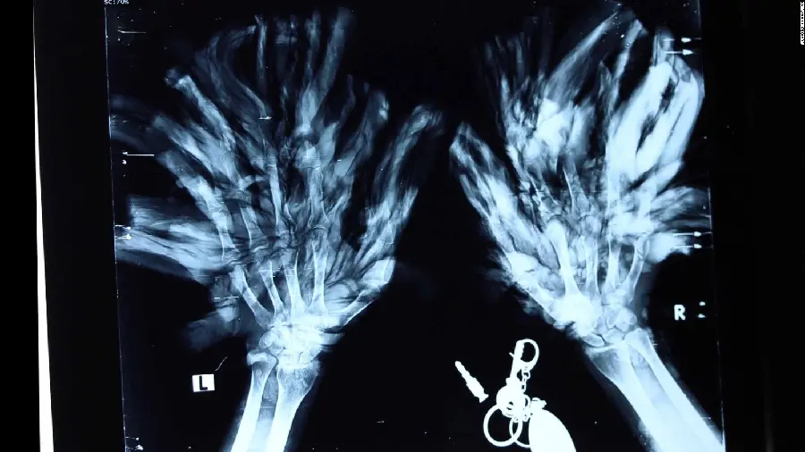 Job X-ray profile picture of branchy trees 