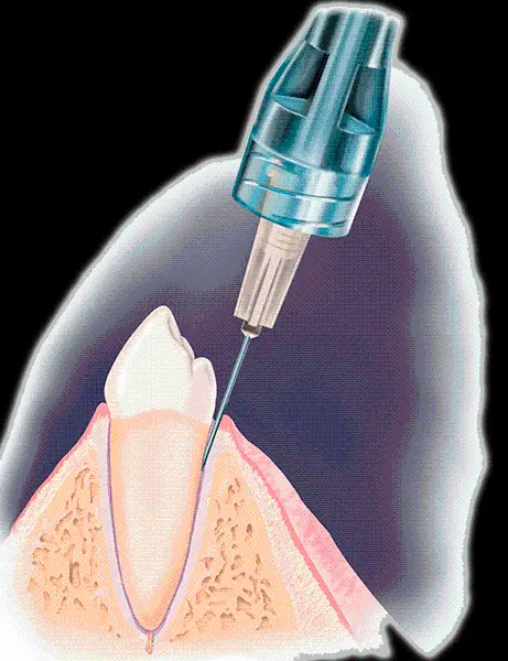 Cropped png image of a tooth being injected