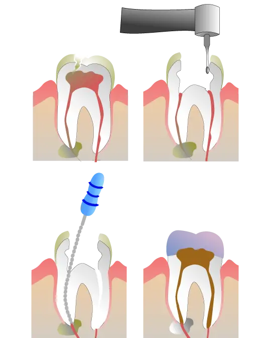 Cropped png image of the stages of implants and dental implants 