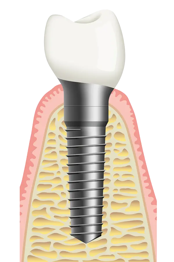 Graphic image of a screw-type denture implant in PNG format