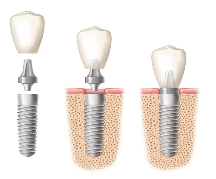 Download a photo of a tooth with an implant or a screw in PNG format